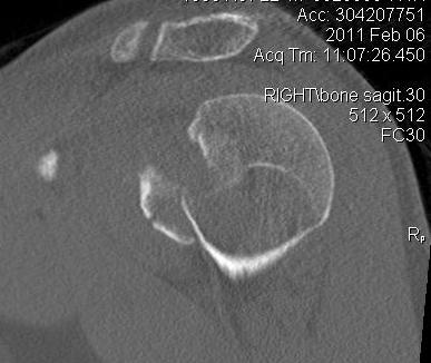 Posterior Shoulder Dislocation Anterior Hill Sachs